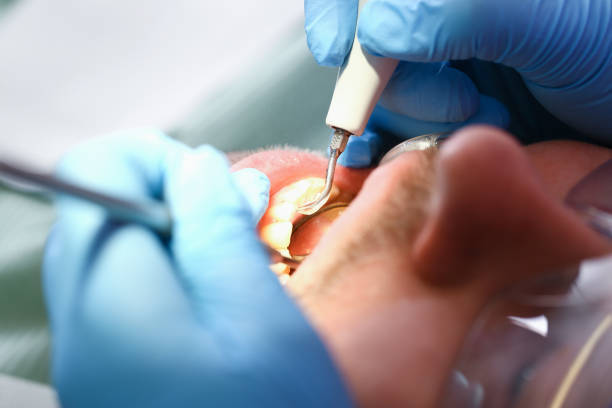Best Broken or Cracked Tooth Emergency Dentist in USA